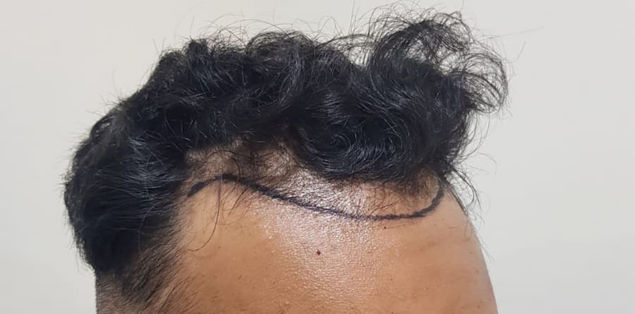 before-after side view