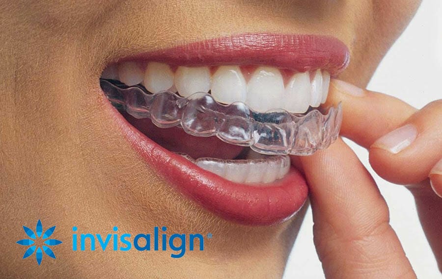 Candid vs Byte vs Invisalign Which is the best teeth aligner kit for